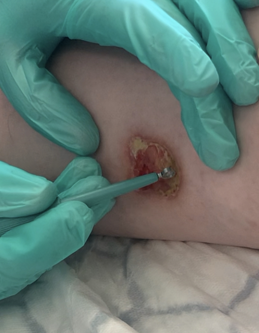 Sharp Debridement over a wound